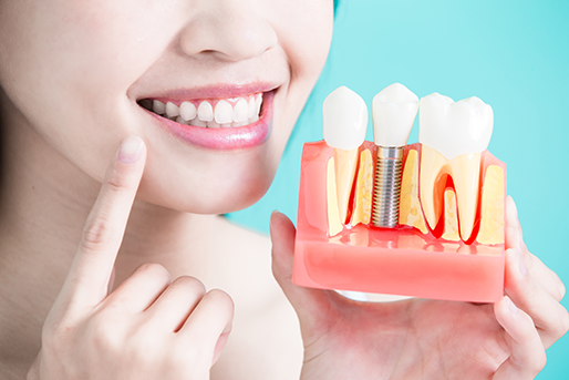 Caring for Dental Implants - Woman holding a dental implant.